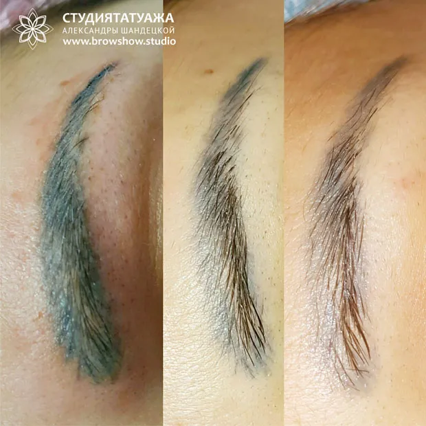 Удаление татуажа