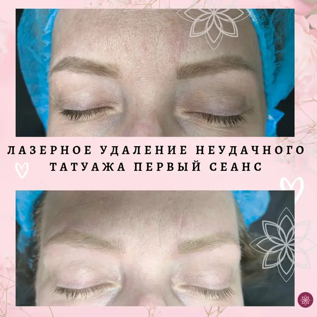 Лазерное удаление татуажа