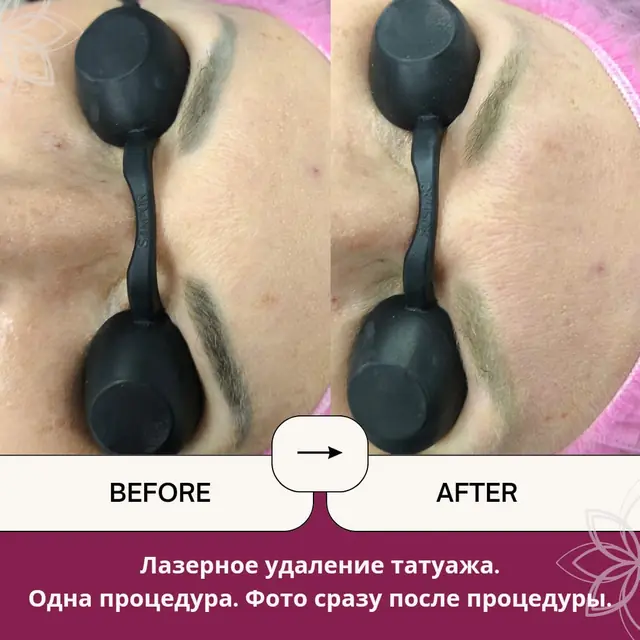 Лазерное удаление татуажа