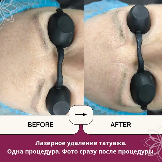 Лазерное удаление татуажа