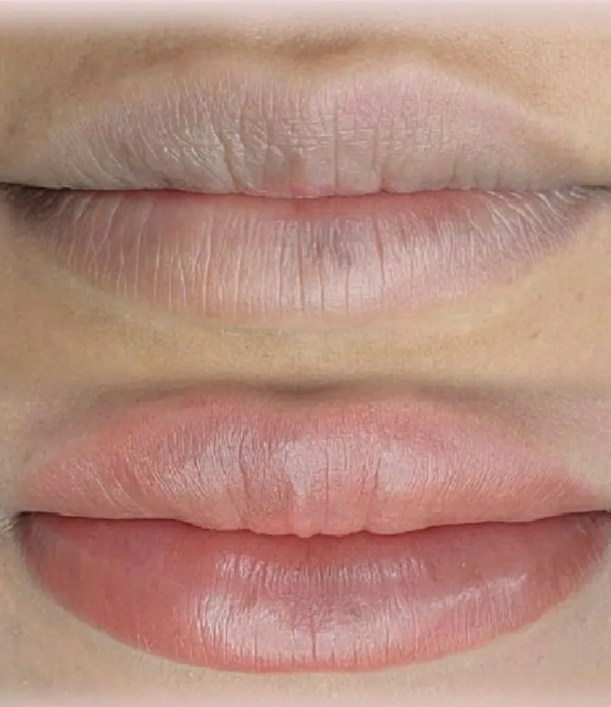 Blue Lips (Cyanosis): There is a Way Out!